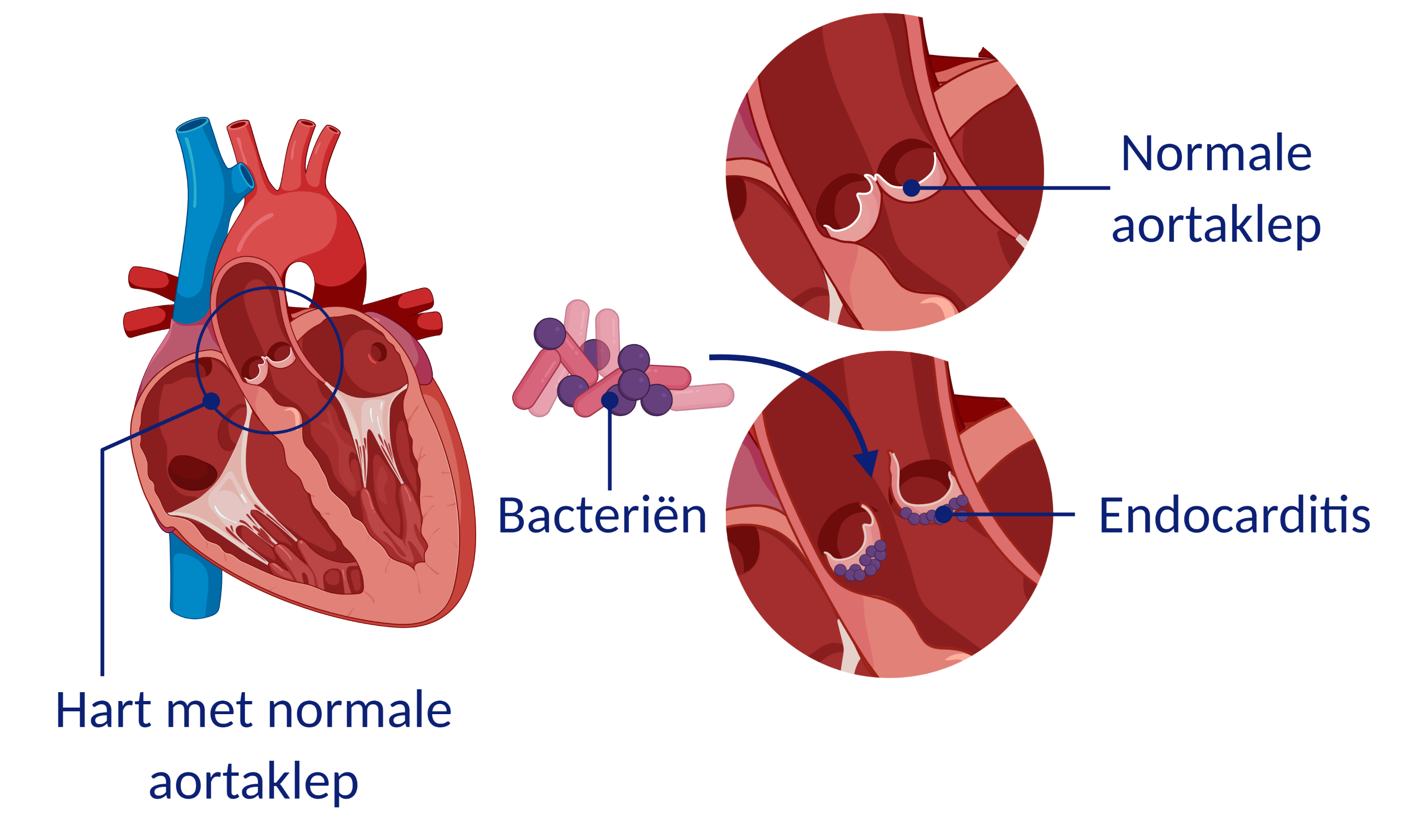 erasmus-mc-pati-ntfolder-endocarditis